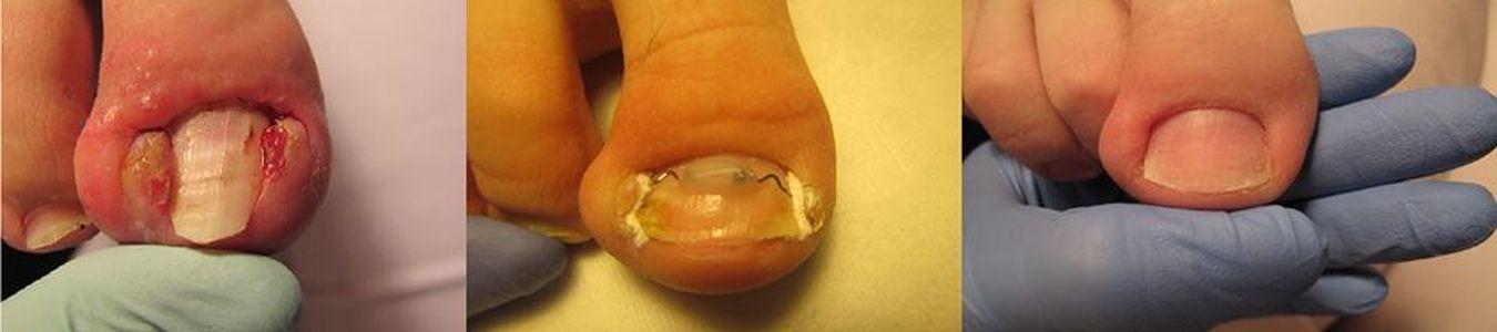 Leczenie wrastającego paznokcia klamrą VHO 17