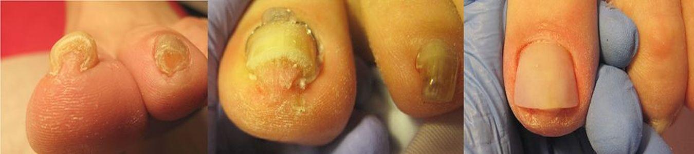 Leczenie wrastającego paznokcia klamrą VHO 15