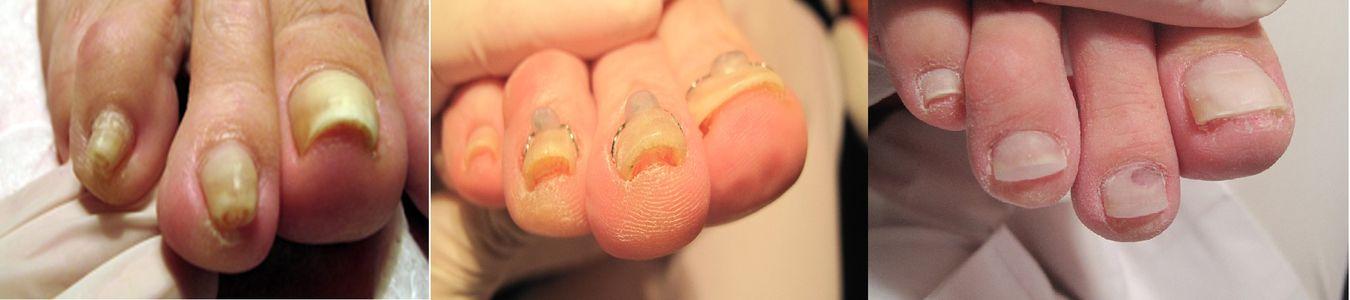 Leczenie wrastającego paznokcia klamrą VHO 12