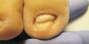 Kobiecy paznokieć zakażony dermatofitami