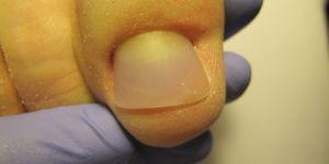 Uprzednio zdeformowany paznokieć zrekonstruowany masą akrylową