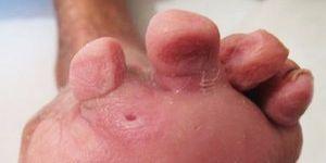 Dziecięca stopa po zabiegu leczenia stopy cukrzycowej