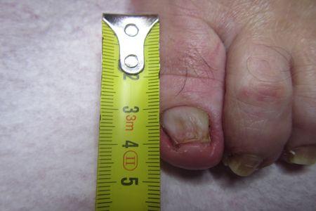 Wyleczone z grzybicy paznokcie u stopy