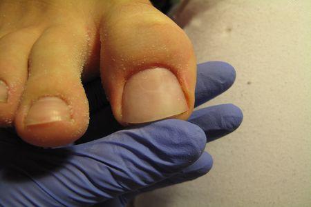 Zdrowy paznokieć po trzech miesiącach leczenia