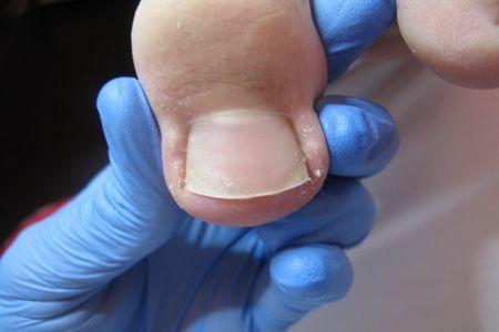 Zdrowy paznokieć po wykonywaniu tamponad