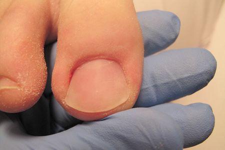 Zdrowy paznokieć kobiety po roku kuracji