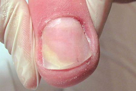 Zdrowy paznokieć po zastosowaniu klamer VHO i preparatów leczniczych