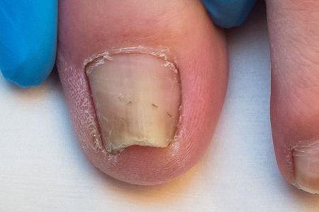 Przypadek zwijającego się paznokcia
