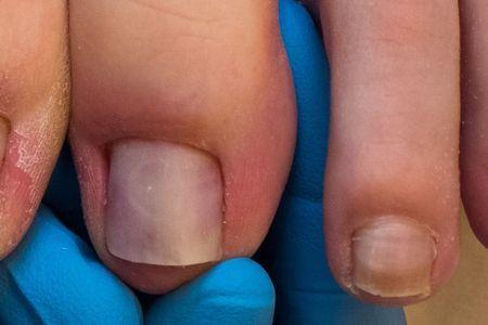 Wyleczony problem wrastającego paznokcia