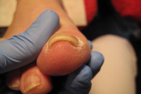 Pacjentka z problemem wrastających paznokci