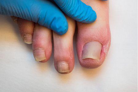 Wrastający paznokieć w stopie faceta wyleczony przy pomocy Rekonstruktor Zdrowe Stopy