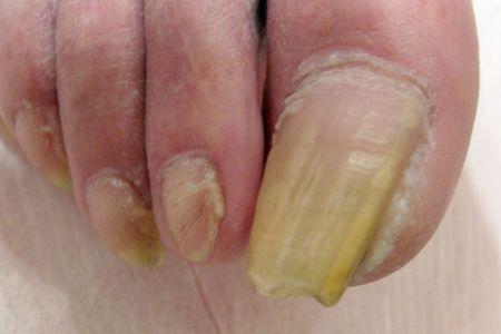 Zmieniono grzybiczo płytka paznokciowa