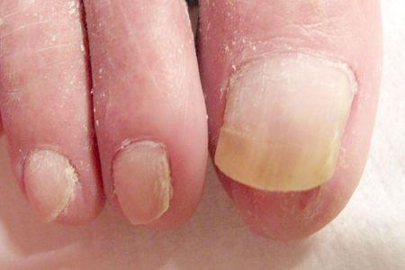 Płytka paznokciowa po współpracy z dermatologiem i podologiem