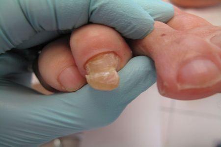 Przerośnięty paznokieć trzeciego palca u stopy